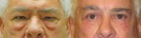 65-74 year old man treated with Eyelid Surgery