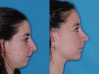 18-24 year old woman treated with Chin Surgery