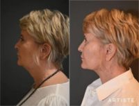 57 year old woman treated with Neck Lift