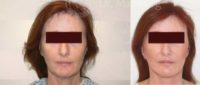 52 year old woman treated with Facelift
