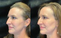 45-54 year old woman treated with Dermal Fillers