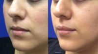 25-34 year old woman treated with Juvederm for lip fullness.