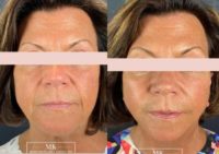 Woman treated with Lower Facelift, Facial Fat Transfer