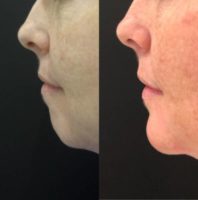 35-44 year old woman treated with Chin Filler