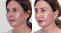 Woman treated with Neck Lift, Facelift