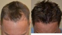 35-44 year old man treated with ARTAS Robotic Hair Transplant