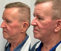 65-74 year old man treated with Deep Plane Facelift, Neck Lift