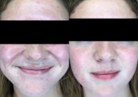 18-24 year old gender nonconforming person treated with HydraFacial