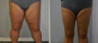 45-54 year old woman treated with Thigh Lift