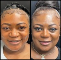 35-44 year old woman treated with African American Rhinoplasty, Rhinoplasty