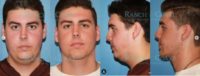 18-24 year old man treated with Neck Lift