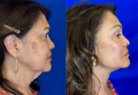 65-74 year old woman treated with Deep Plane Facelift, Facial Fat Transfer, Eyelid Surgery, Laser Resurfacing