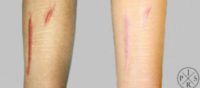 Scar Removal by carbon dioxide laser