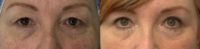 55-64 year old woman treated with Upper Eyelid Surgery