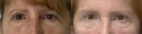 55-64 year old woman treated with Upper Eyelid Surgery