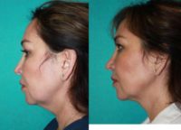 45-54 year old woman treated with Kybella