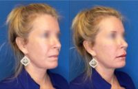 55-64 year old woman treated with Juvederm and Voluma