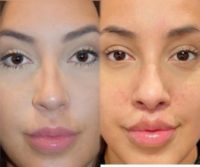 25-34 year old woman treated with Lip Lift