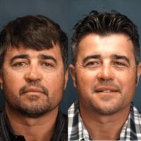 45-54 year old man treated with Revision Rhinoplasty