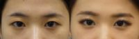 18-24 year old woman treated with Double Eyelid Surgery (Non-Incision)