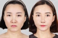25-34 year old woman treated with Double Eyelid Surgery