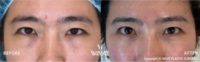 25-34 year old woman treated with Eyelid Surgery