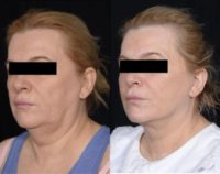 55-64 year old woman treated with Facelift, Necklift and Facial Fat grafting
