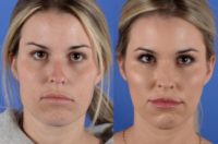 25-34 year old woman treated with FaceTite