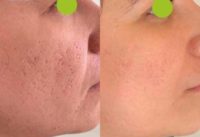 25-34 year old woman treated with Microneedling RF