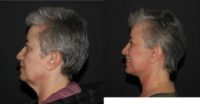 55-64 year old woman treated with Facelift, CO2 Laser