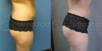 Woman treated with Brazilian Butt Lift