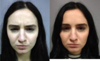 24 year old woman treated with Botox