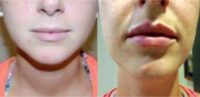 25-34 year old woman treated with Injectable Lip Fillers