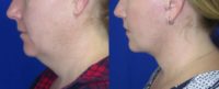 41 year old woman treated with Facelift