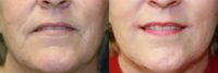 65-74 year old woman treated with Lip Lift