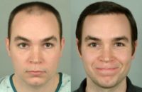 27 year old man treated with Hair Transplant