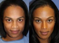 Woman treated with Facial Feminization Surgery