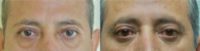 55-64 year old man treated with Double Eyelid Surgery