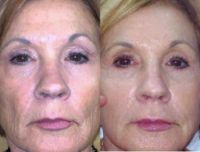 Patient Treated with Sculptra