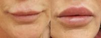 55-64 year old woman treated with Lip Augmentation