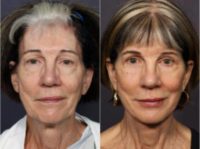 65-74 year old woman treated with Deep Plane Facelift