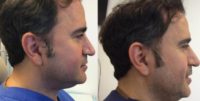 35-44 year old man treated with Kybella