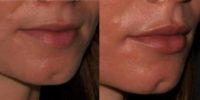 18-24 year old woman treated with Lip Fillers, Dermal Fillers
