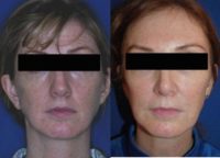 45-54 year old female treated with Revision Rhinoplasty