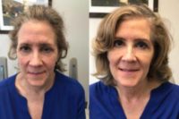 55-64 year old woman treated with Restylane Lyft