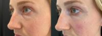 Tear Trough treated with Injectable Fillers
