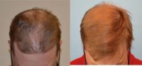 Male aged 30's one year post-op ARTAS Robotic FUE