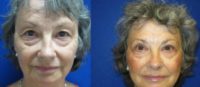 65 year old woman for upper eyelid rejuvenation surgery