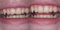 18-24 year old woman treated with Dental Bonding