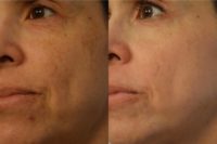 45-54 year old woman treated for Melasma